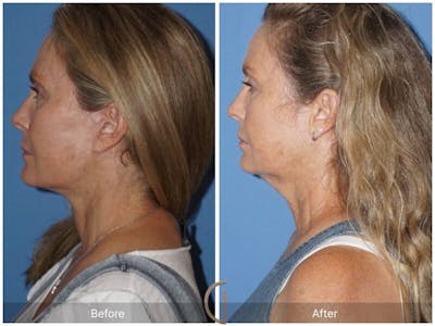 Facelift 50s Before & After Gallery - Patient 425474 - Image 1