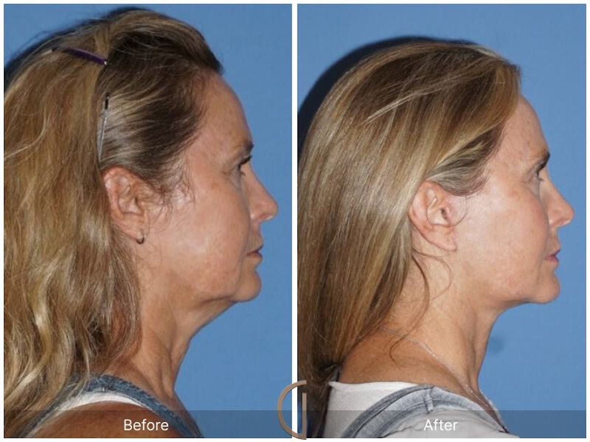 Facelift 50s Before & After Gallery - Patient 425474 - Image 3