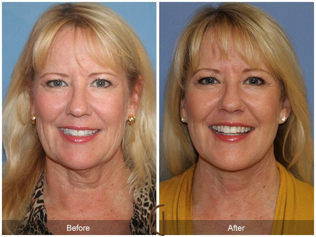 Facelift 60s Before & After Gallery - Patient 203721 - Image 2