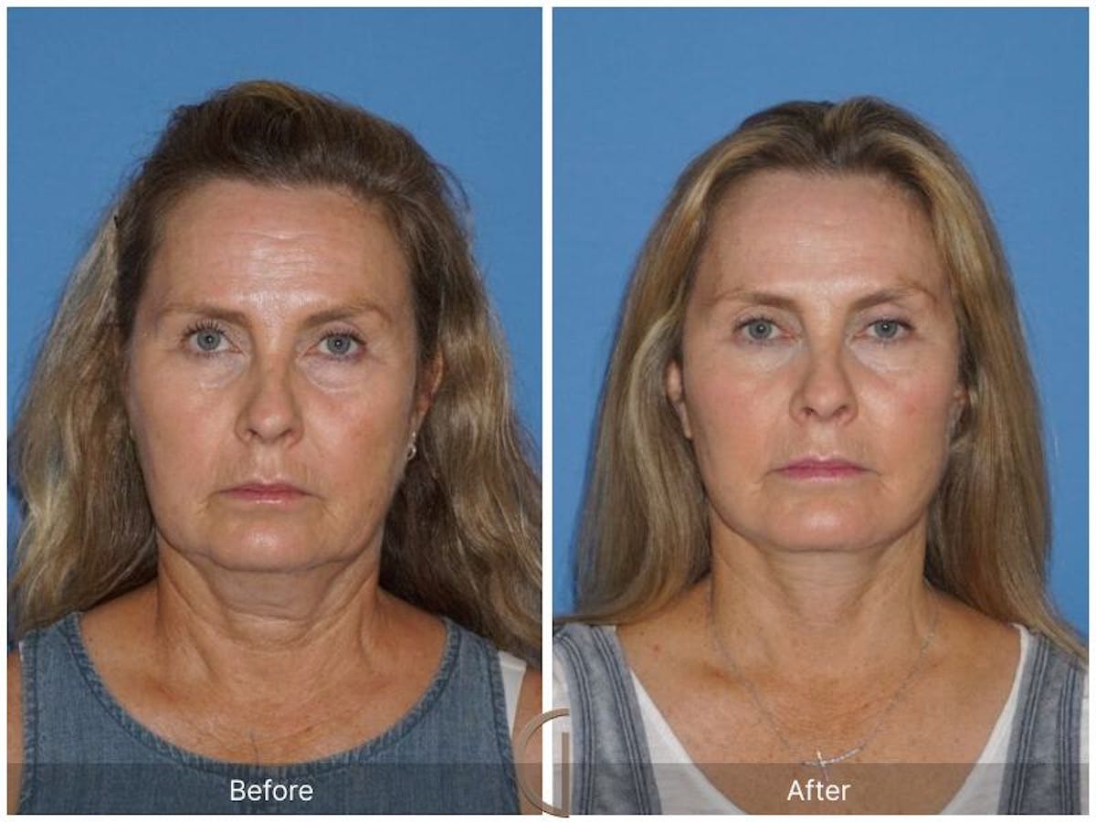 Facelift 50s Before & After Gallery - Patient 425474 - Image 2