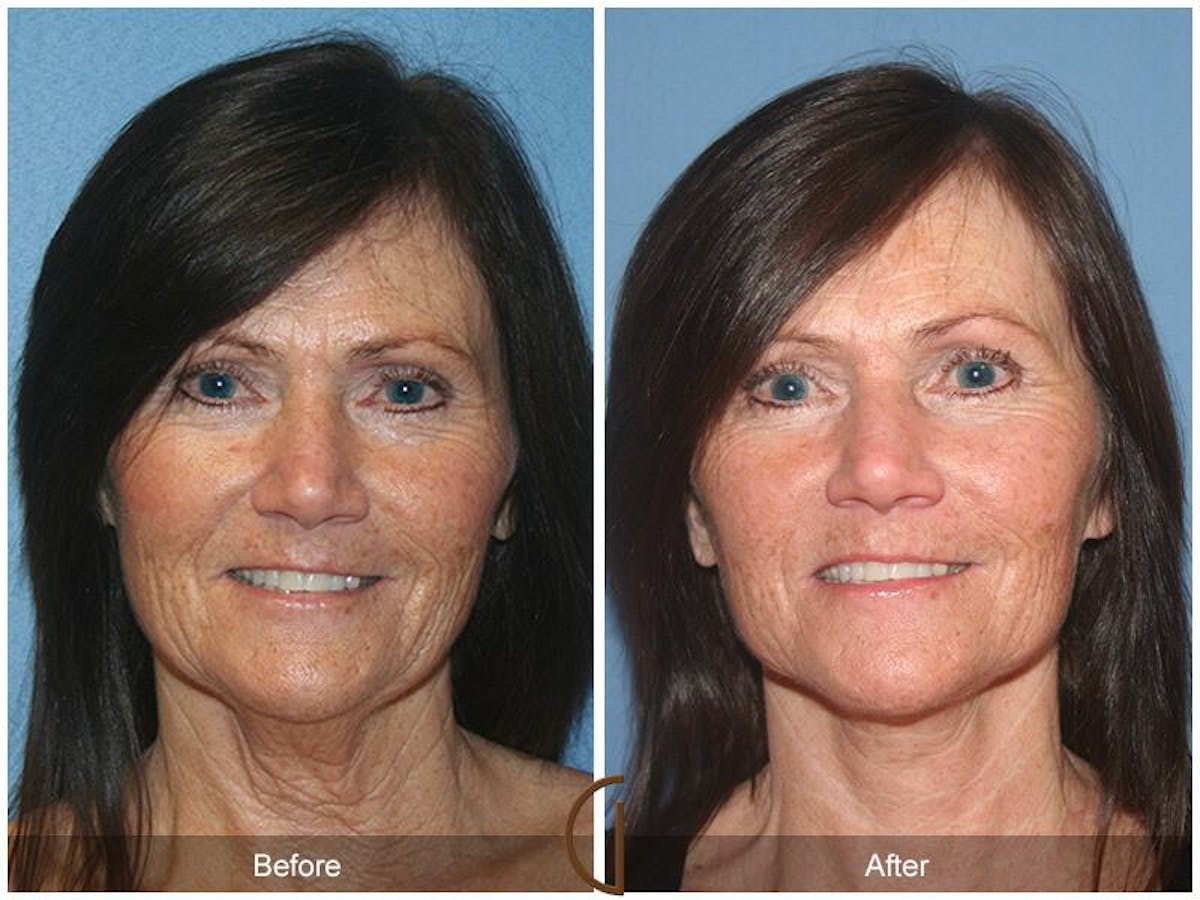 Facelift 50s Before & After Gallery - Patient 175249 - Image 2