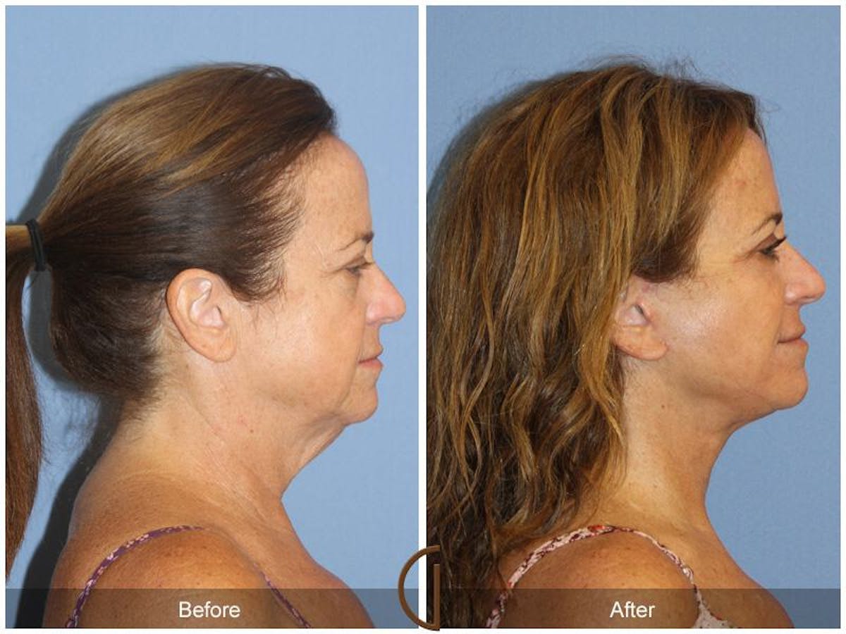 Facelift 50s Before & After Gallery - Patient 688644 - Image 3