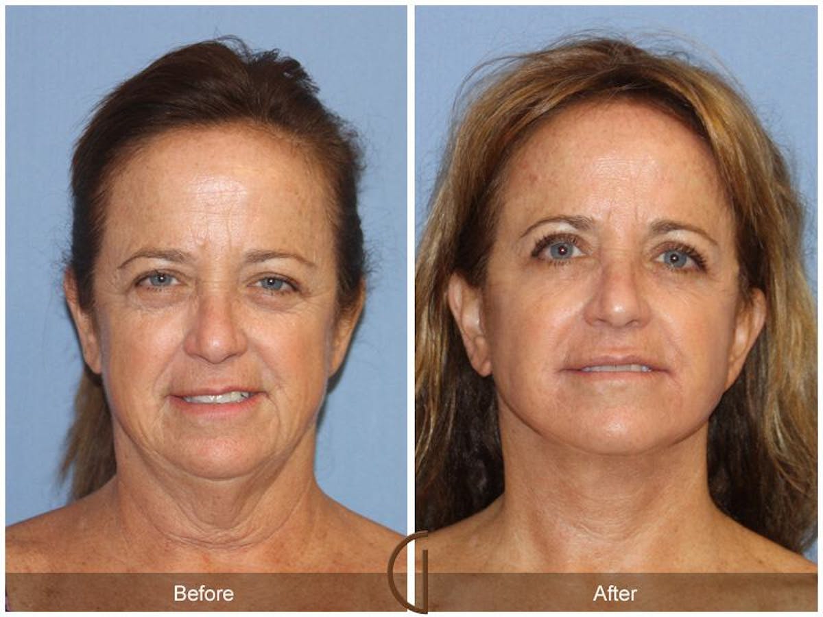 Facelift 50s Before & After Gallery - Patient 688644 - Image 2
