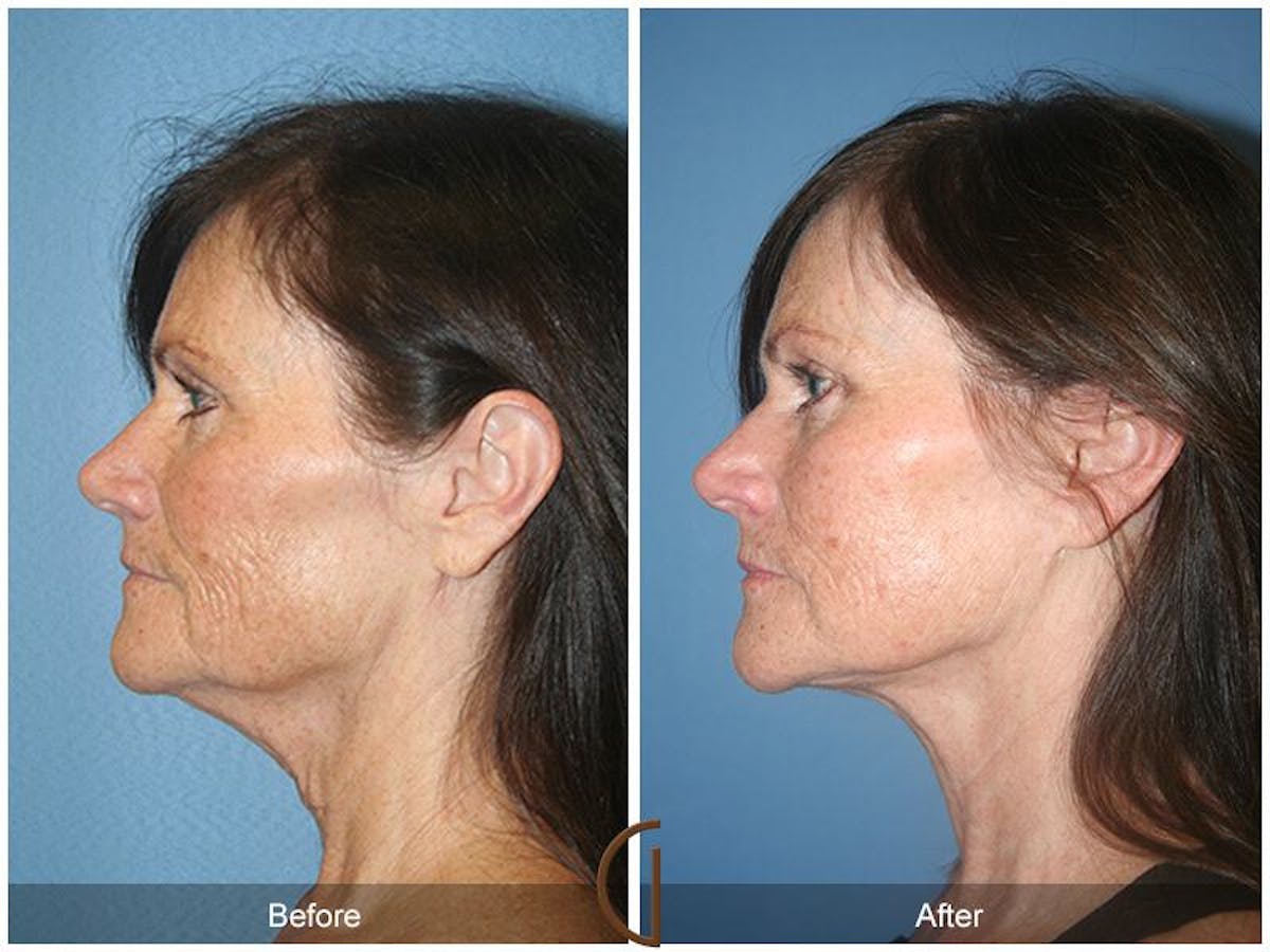 Facelift 50s Before & After Gallery - Patient 175249 - Image 1
