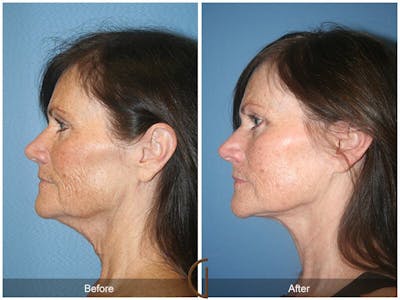 Facelift 50s Before & After Gallery - Patient 175249 - Image 1