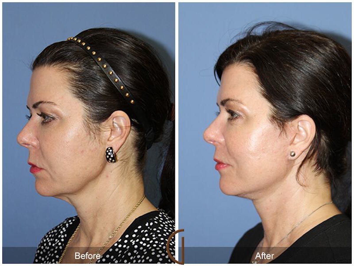 Facelift 50s Before & After Gallery - Patient 394477 - Image 1