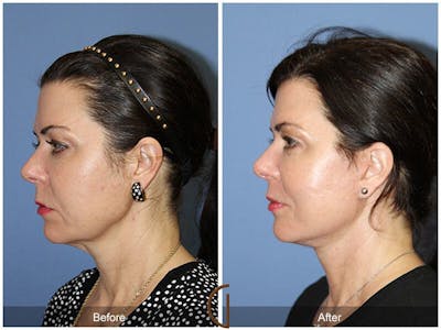 Facelift 50s Before & After Gallery - Patient 394477 - Image 1