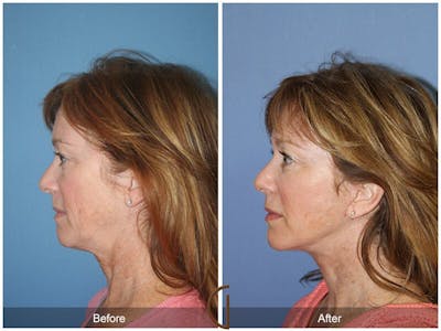 Facelift 50s Before & After Gallery - Patient 176996 - Image 1