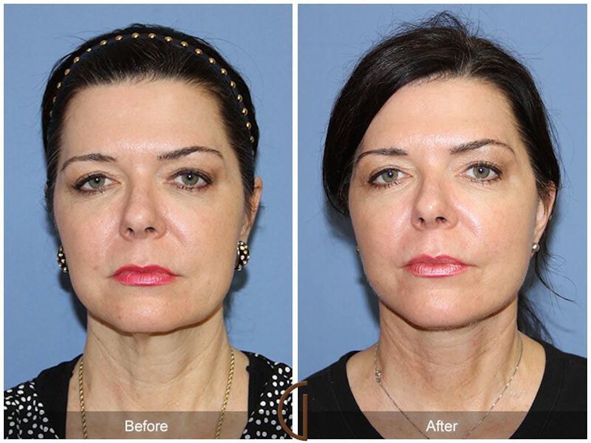 Facelift 50s Before & After Gallery - Patient 394477 - Image 2