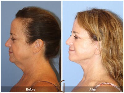 Facelift 50s Before & After Gallery - Patient 688644 - Image 1