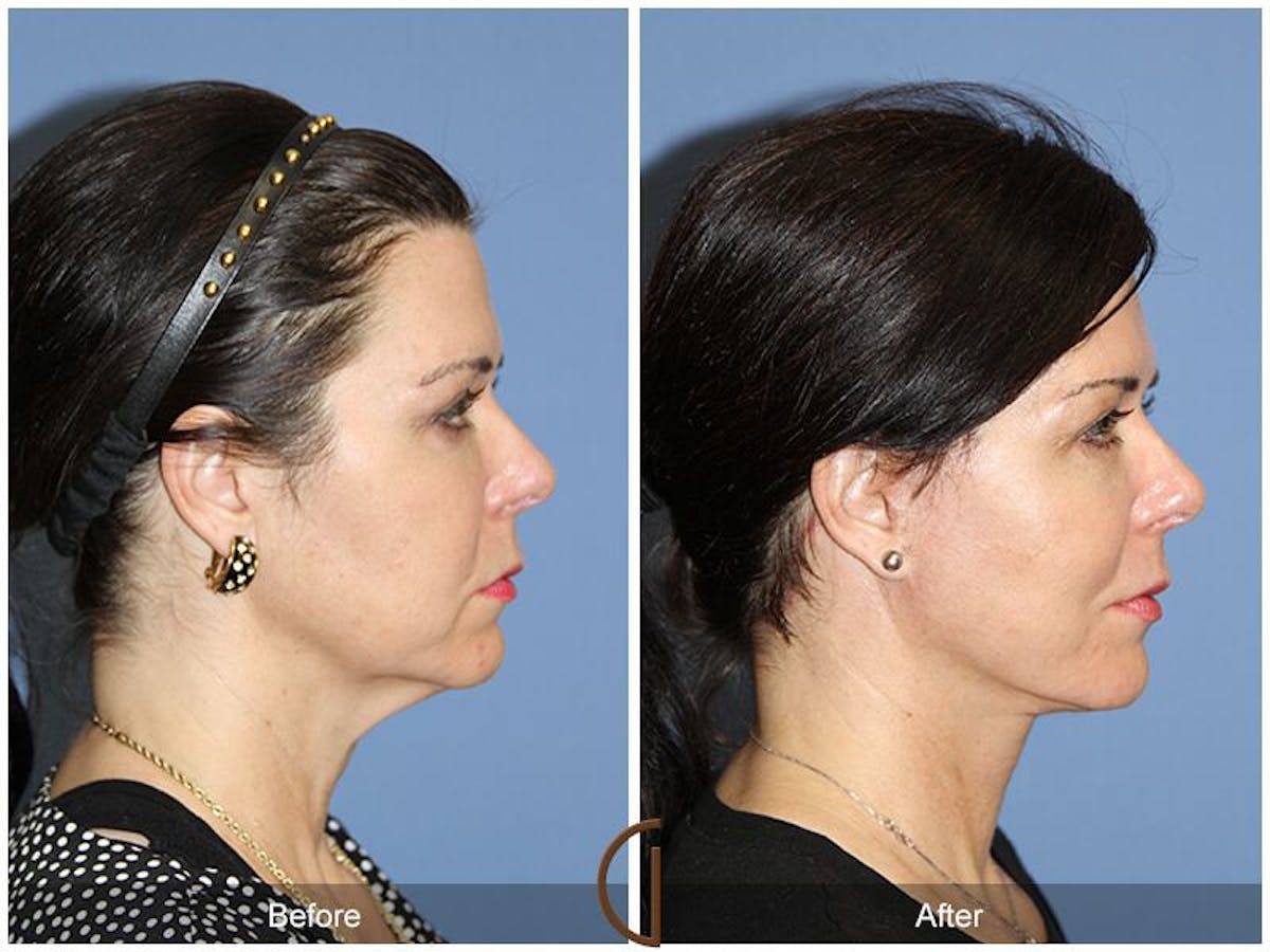 Facelift 50s Before & After Gallery - Patient 394477 - Image 3