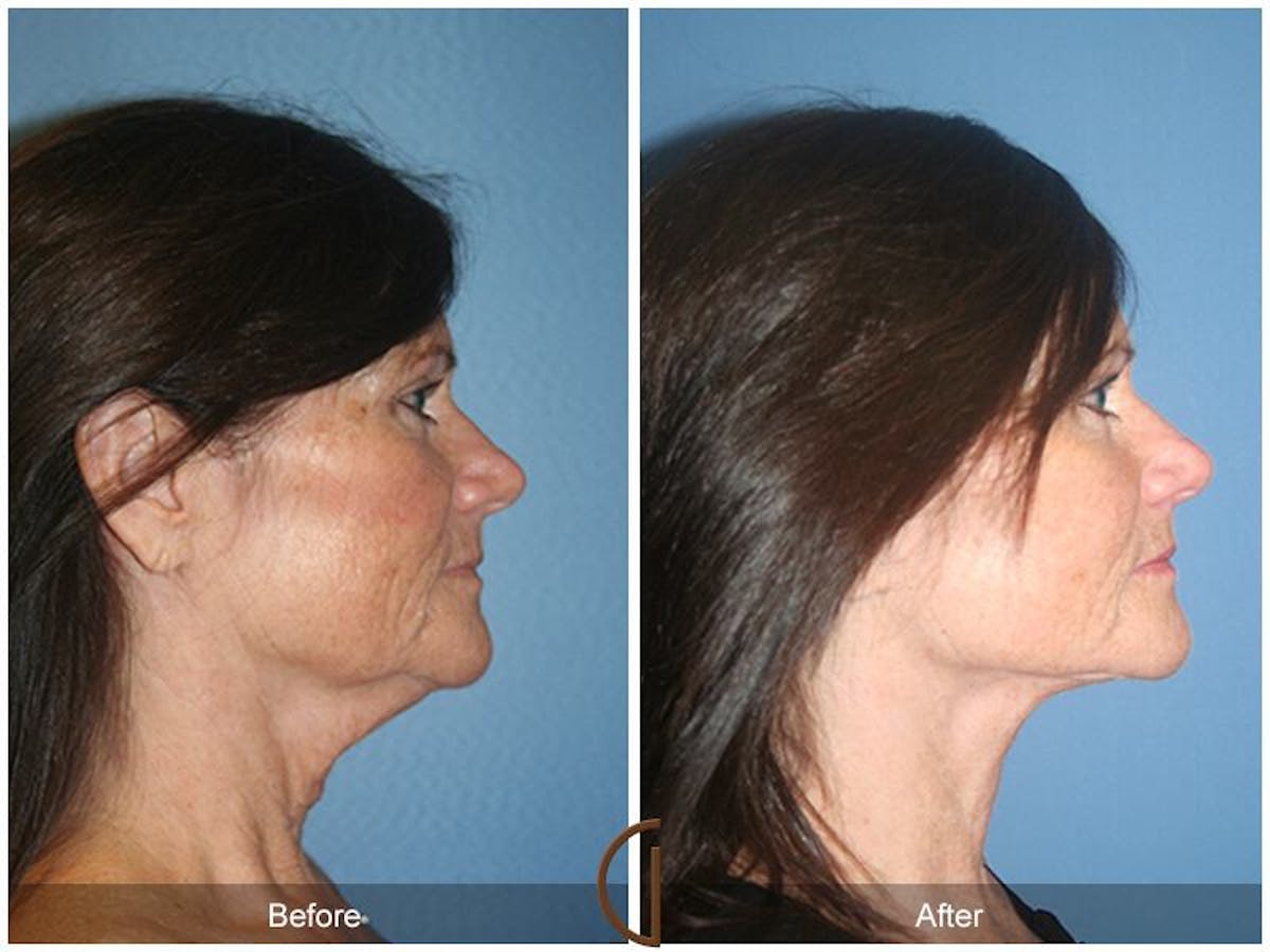 Facelift 50s Before & After Gallery - Patient 175249 - Image 3