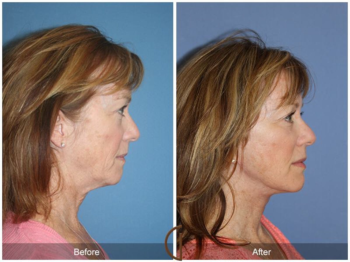 Facelift 50s Before & After Gallery - Patient 176996 - Image 3