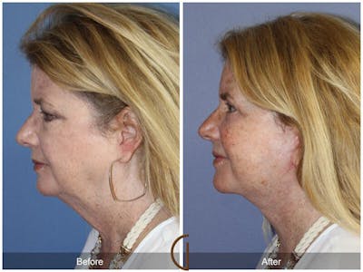 Neck Lift Before & After Gallery - Patient 639539 - Image 1