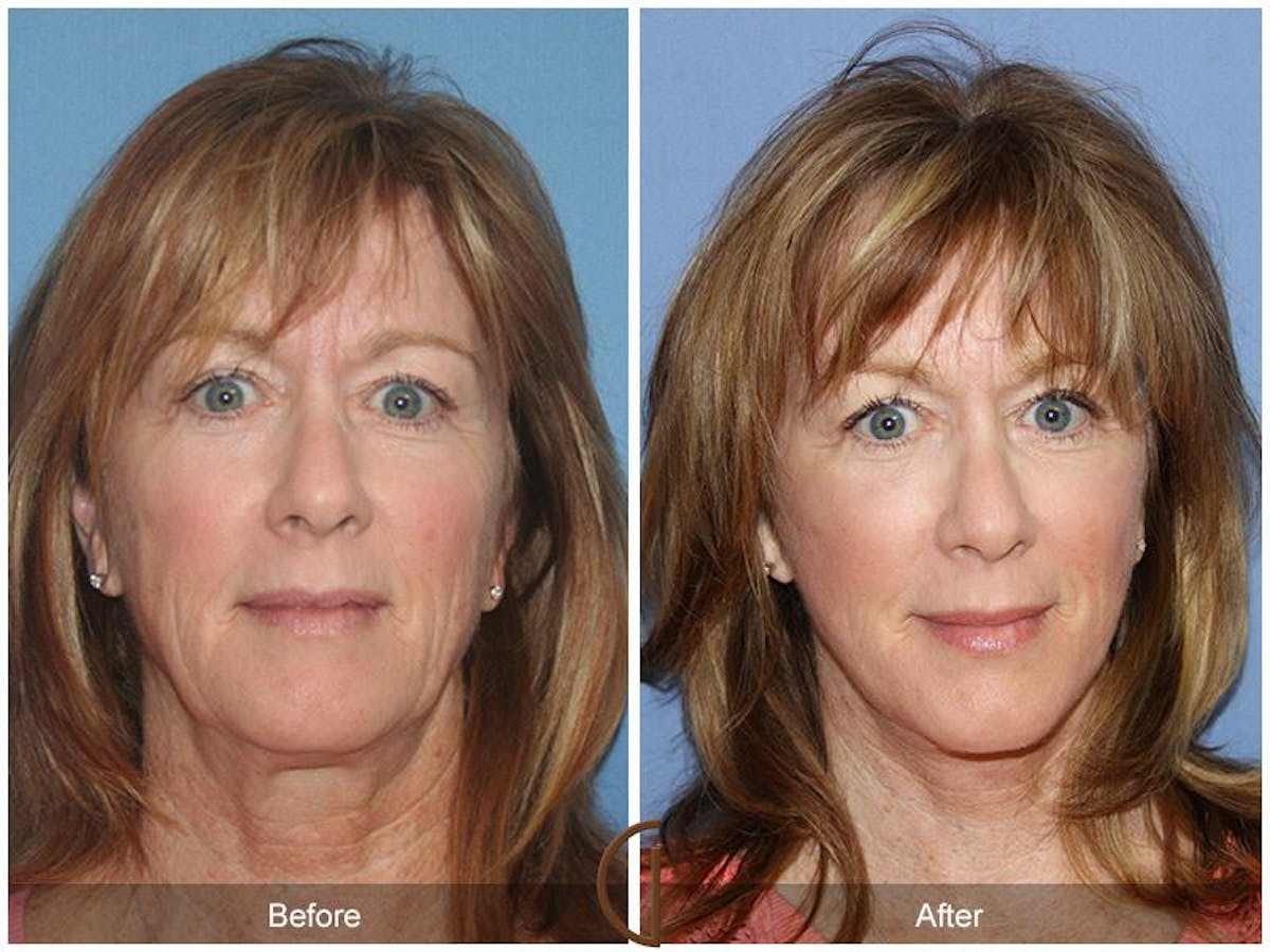 Facelift 50s Before & After Gallery - Patient 176996 - Image 2