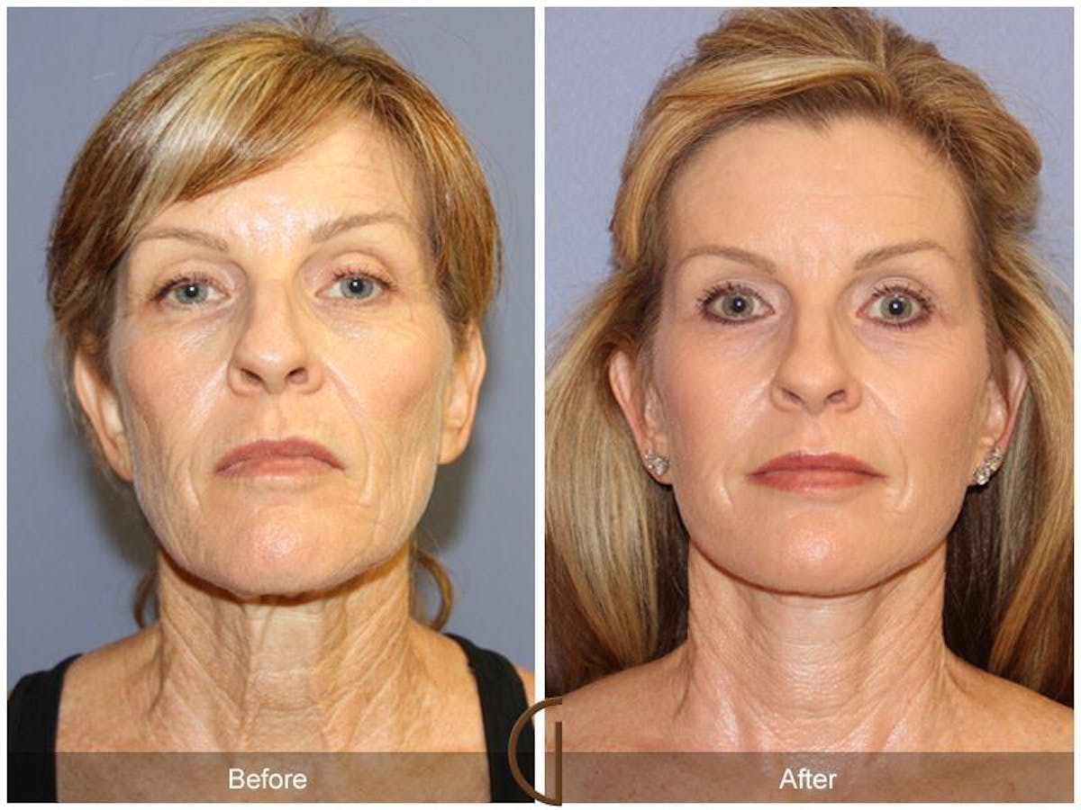 Facelift 50s Before & After Gallery - Patient 844819 - Image 2