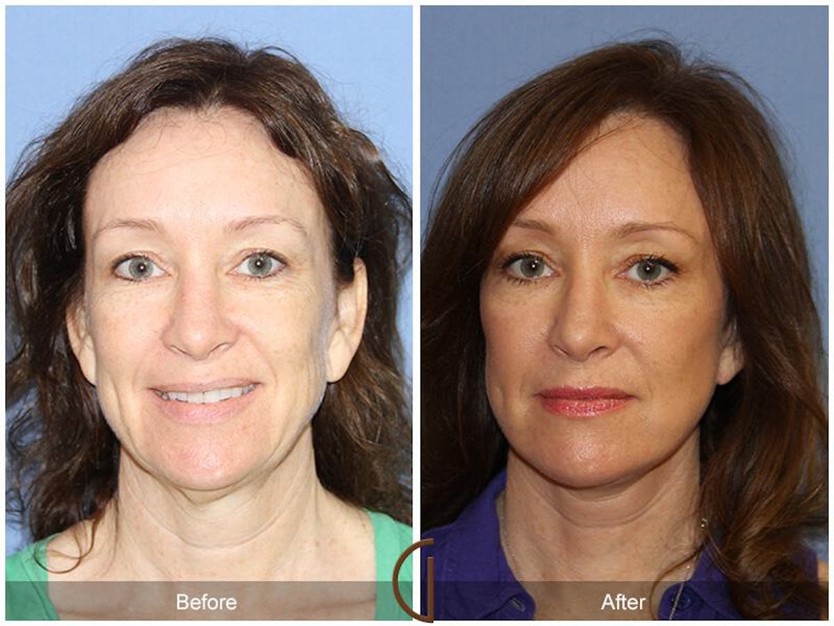 Facelift 50s Before & After Gallery - Patient 348482 - Image 2
