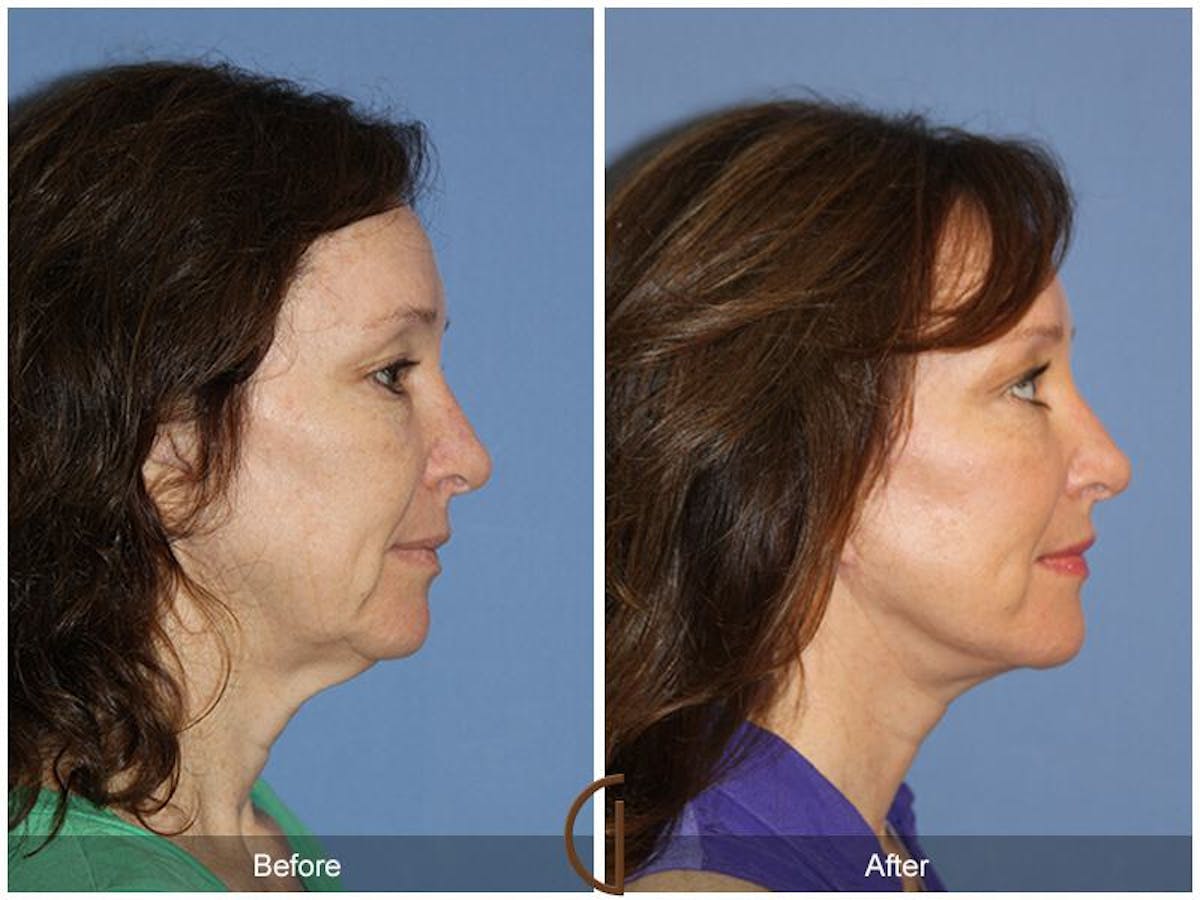 Facelift 50s Before & After Gallery - Patient 348482 - Image 3