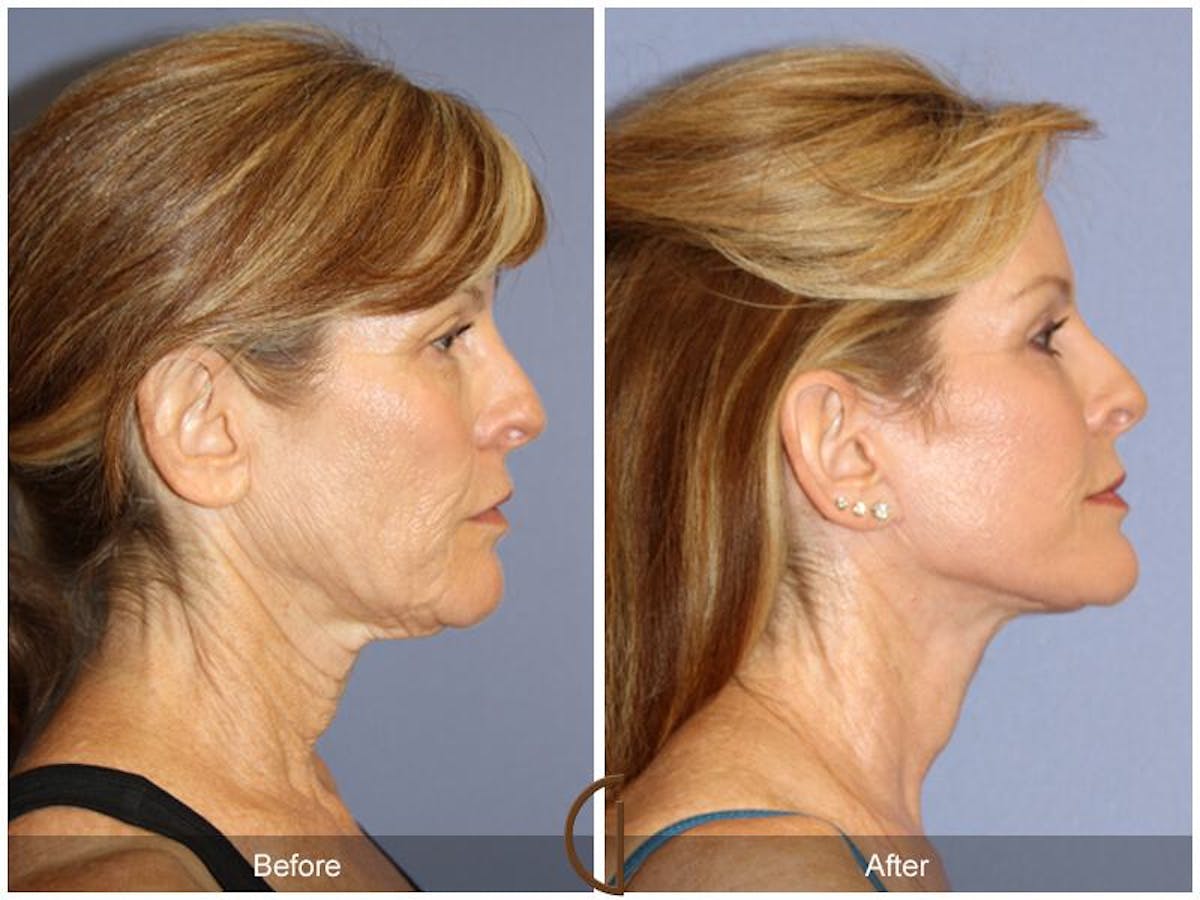 Facelift 50s Before & After Gallery - Patient 844819 - Image 3