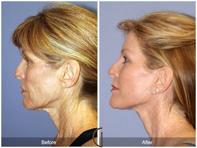 Facelift 50s Before & After Gallery - Patient 844819 - Image 1
