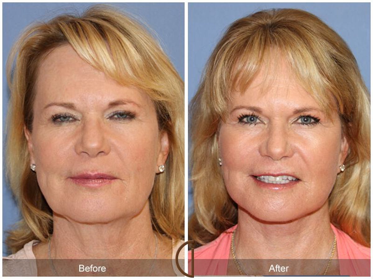 Facelift 60s Before & After Gallery - Patient 206048 - Image 2