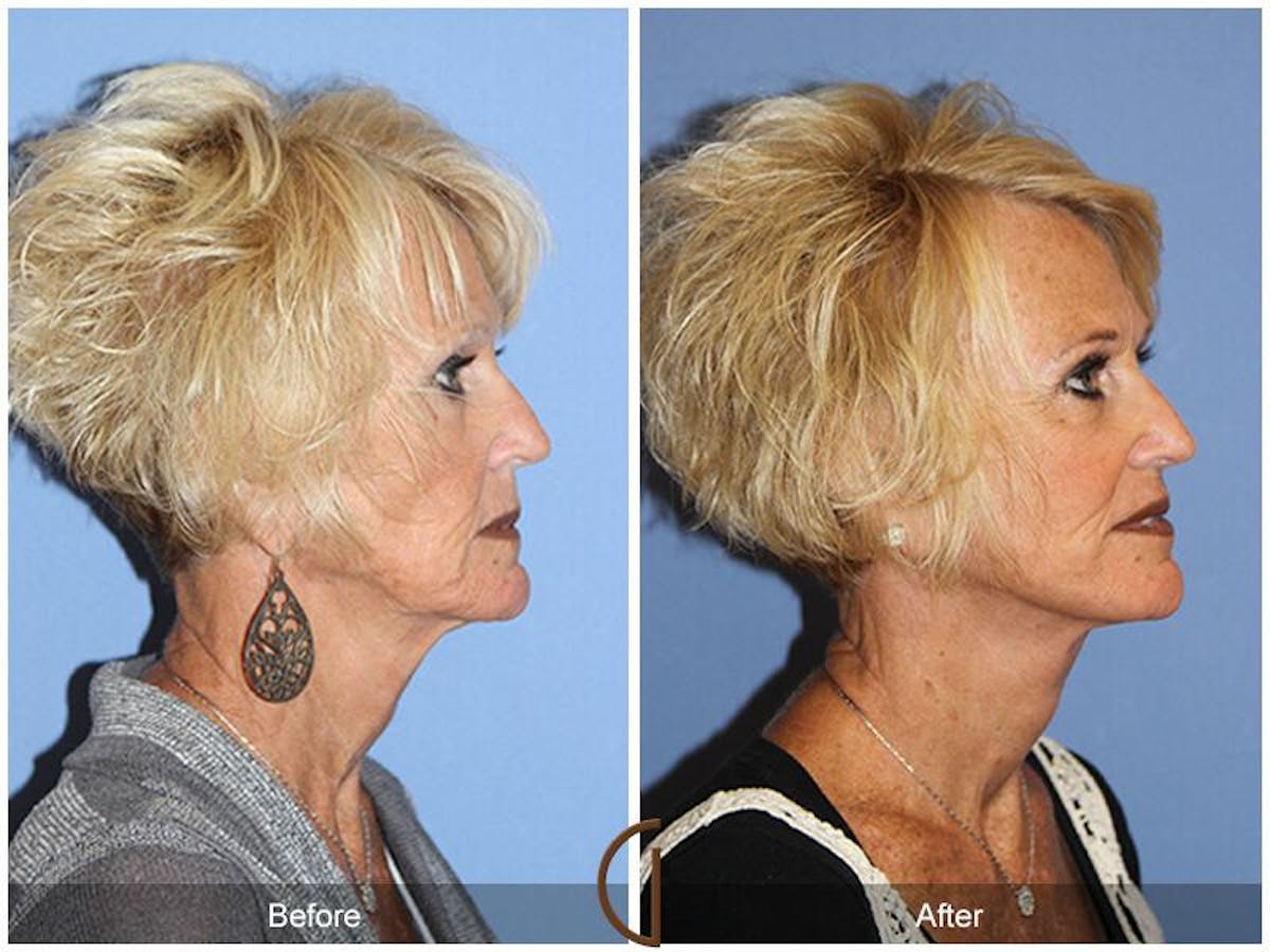 Facelift 60s Before & After Gallery - Patient 122672 - Image 3