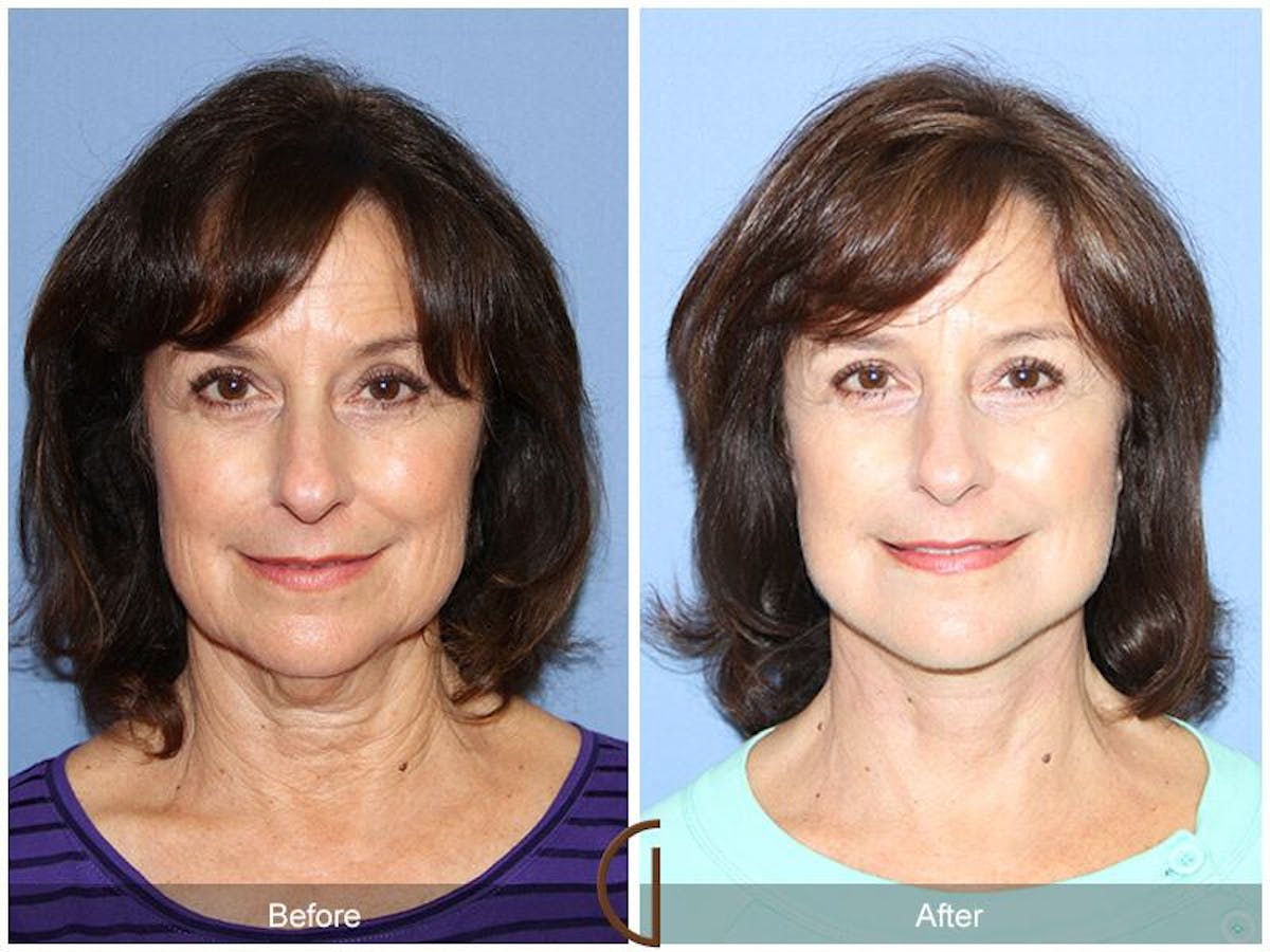 Facelift 60s Before & After Gallery - Patient 414918 - Image 2