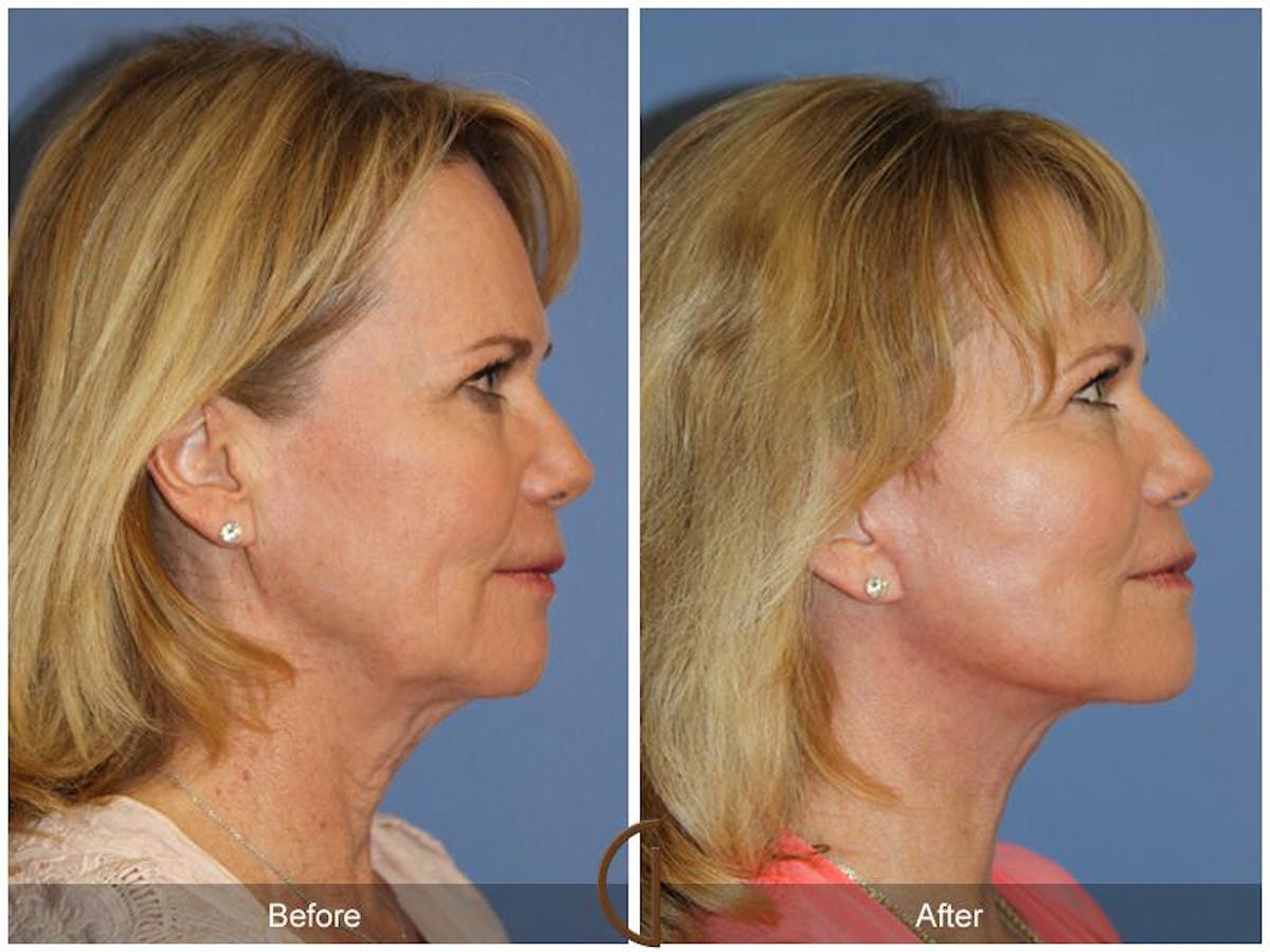 Facelift 60s Before & After Gallery - Patient 206048 - Image 3