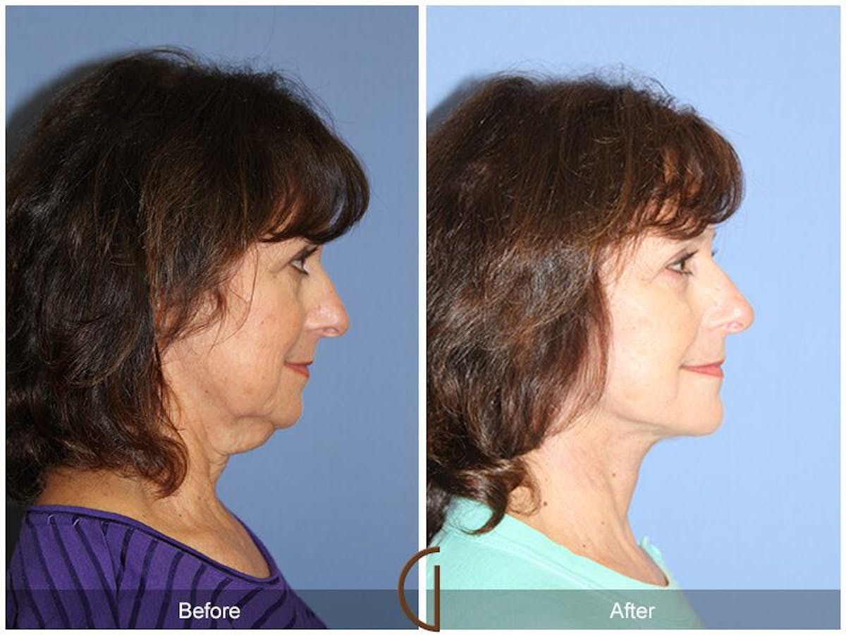 Facelift 60s Before & After Gallery - Patient 414918 - Image 3