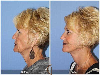 SMAS Facelift Before & After Gallery - Patient 109917 - Image 1