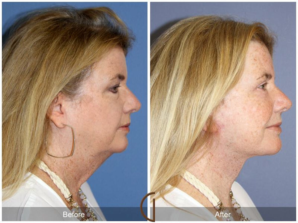 Facelift 60s Before & After Gallery - Patient 192579 - Image 3