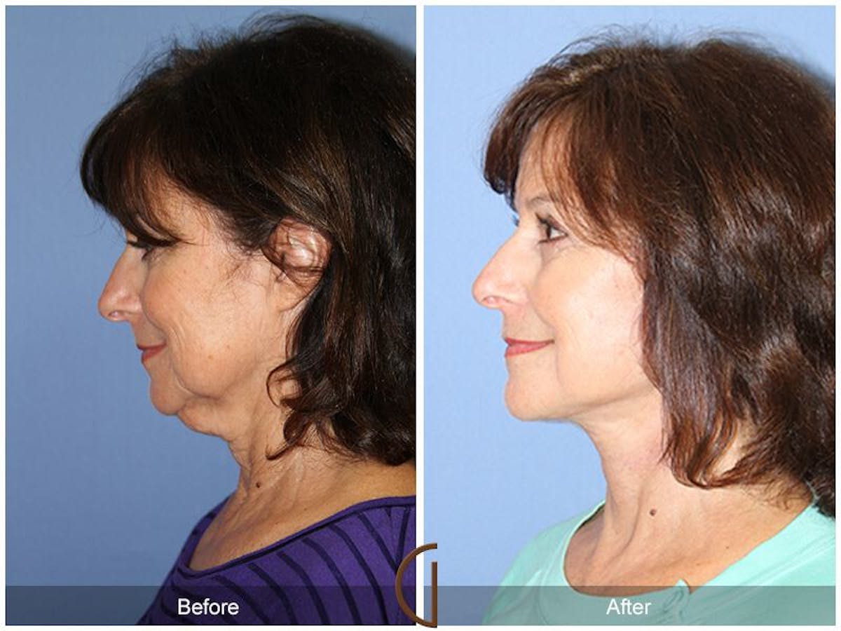 Facelift 60s Before & After Gallery - Patient 414918 - Image 1