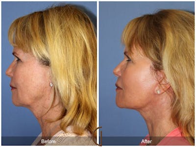 Neck Lift Before & After Gallery - Patient 194467 - Image 1