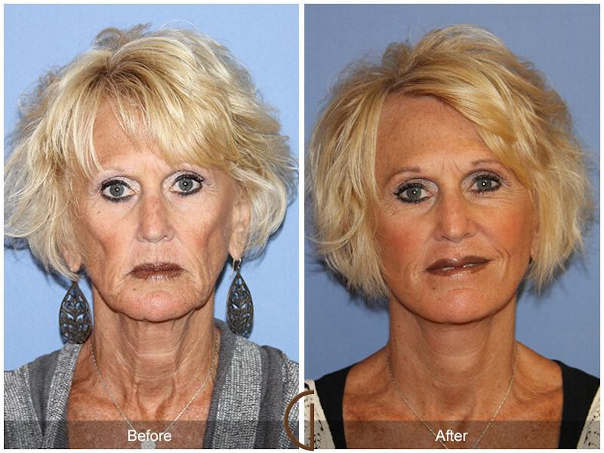 Facelift 60s Before & After Gallery - Patient 122672 - Image 2
