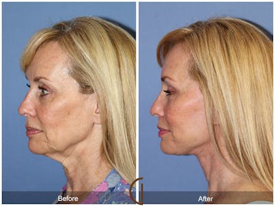 Neck Lift Before & After Gallery - Patient 861874 - Image 1