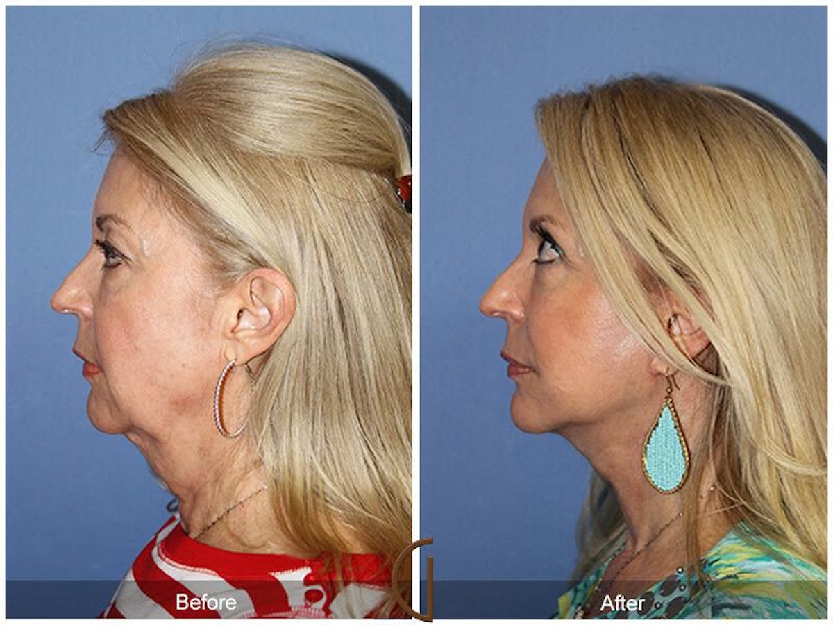 Facelift 60s Before & After Gallery - Patient 379499 - Image 1