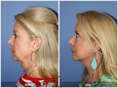 Neck Lift Before & After Gallery - Patient 451144 - Image 1