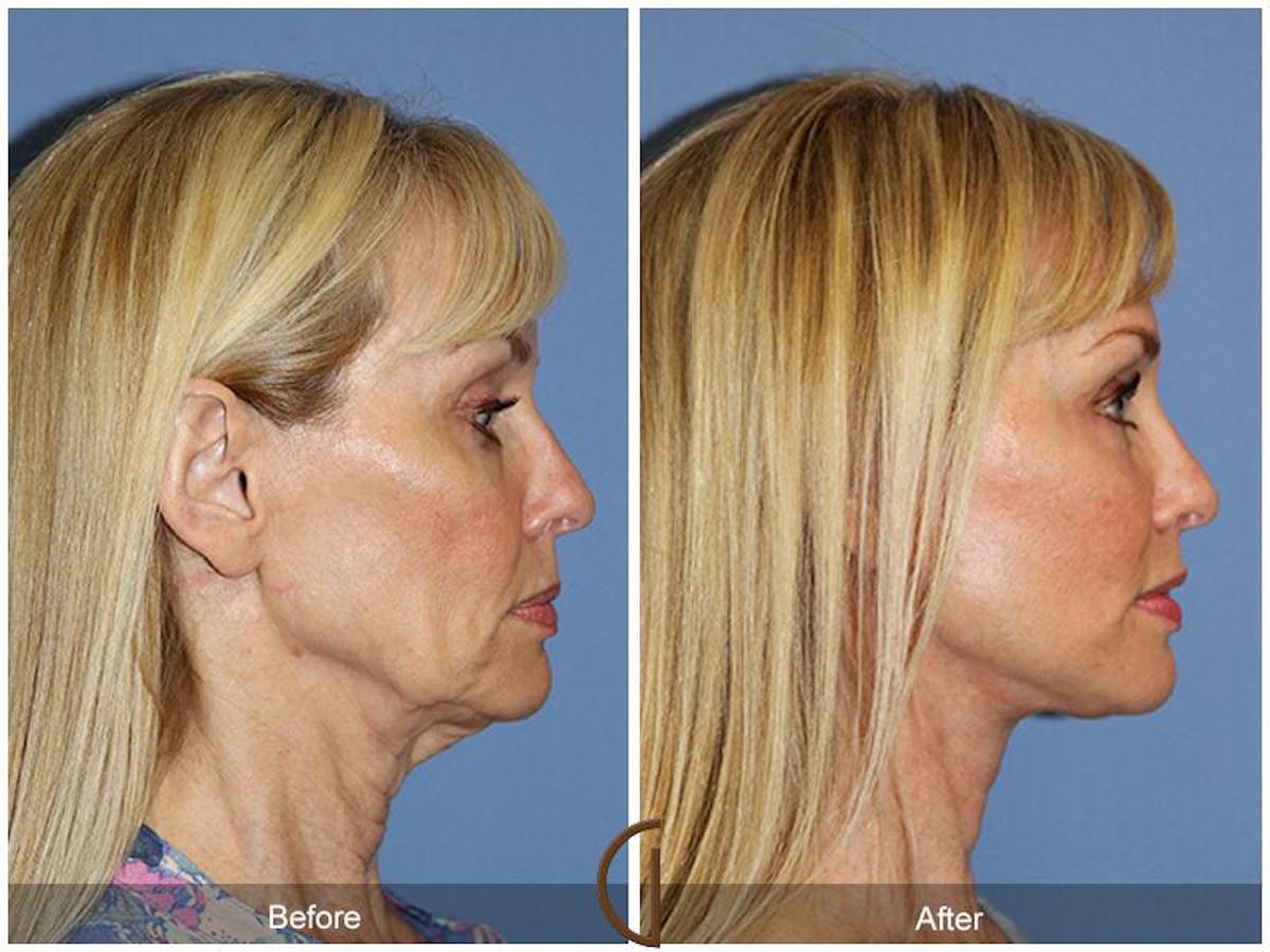 Facelift 60s Before & After Gallery - Patient 144381 - Image 3
