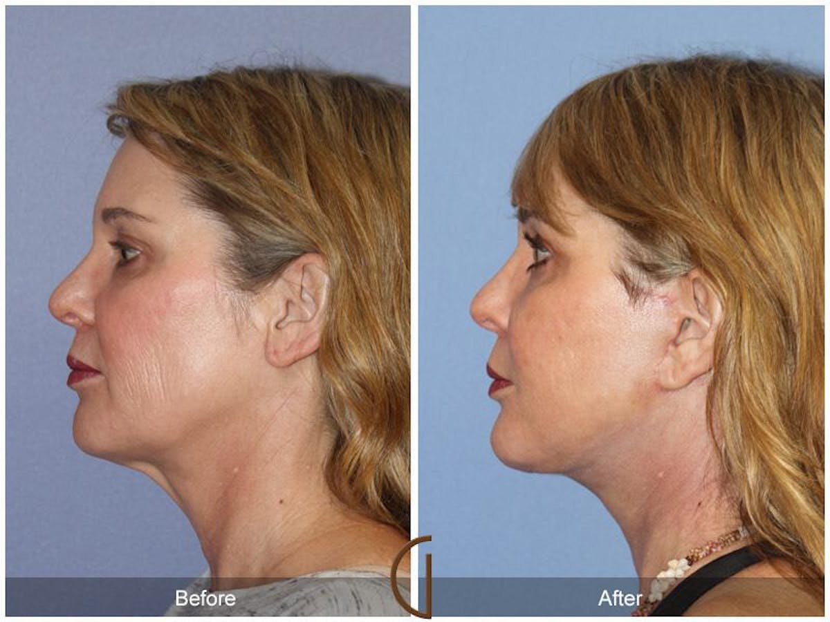 Facelift 40s Before & After Gallery - Patient 132256 - Image 1