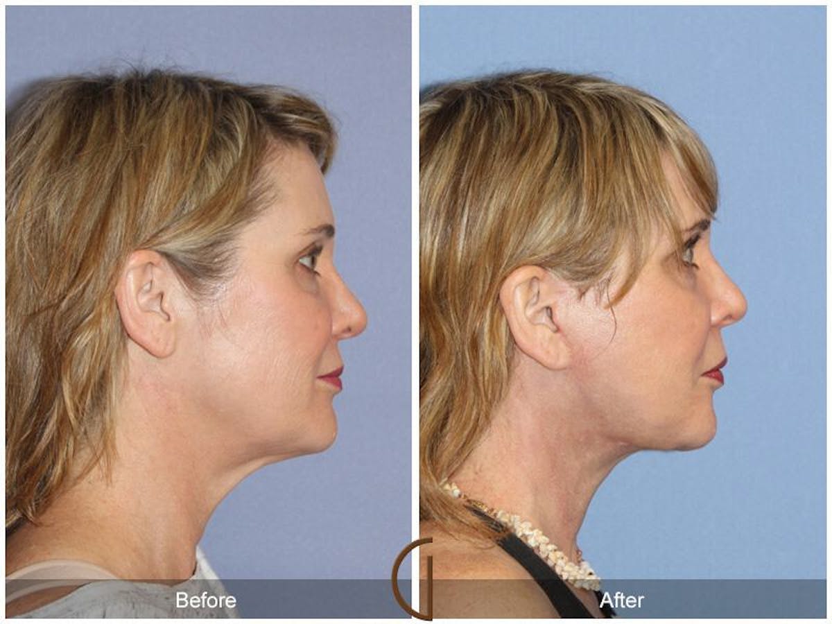 Facelift 40s Before & After Gallery - Patient 132256 - Image 3