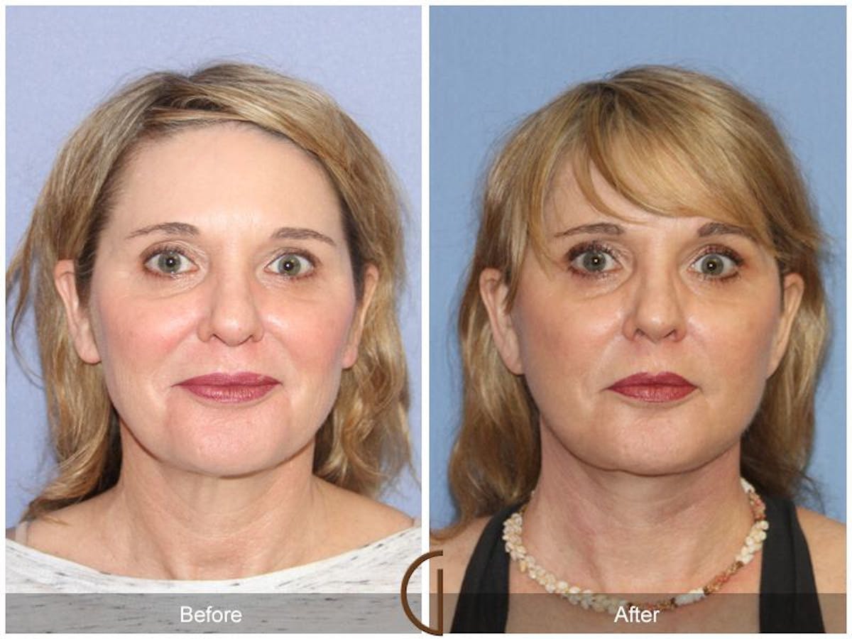 Facelift 40s Before & After Gallery - Patient 132256 - Image 2