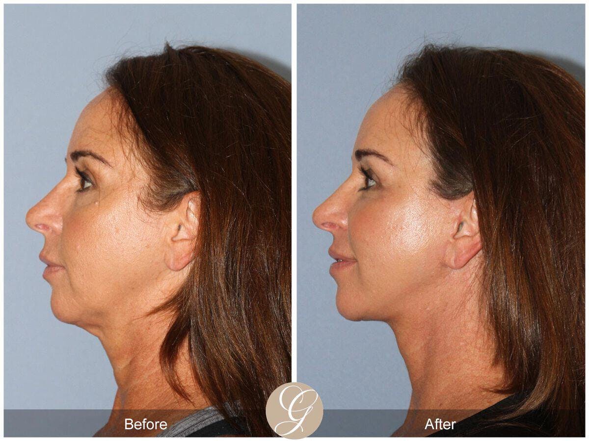 Facelift 40s Before & After Gallery - Patient 409053 - Image 1