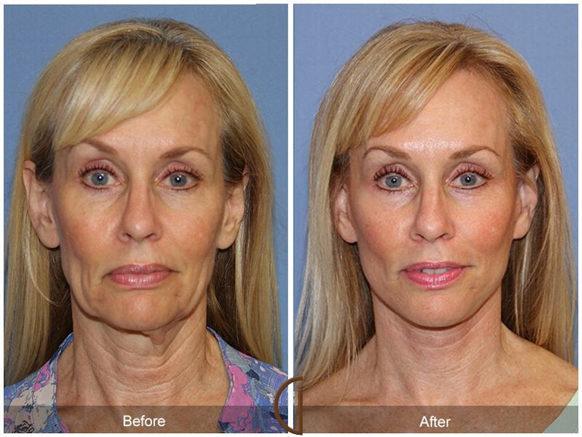 Facelift 60s Before & After Gallery - Patient 144381 - Image 2