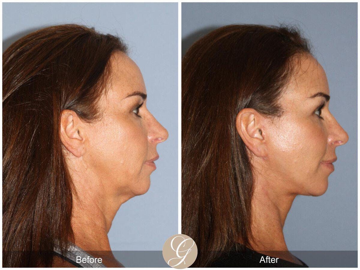 Facelift 40s Before & After Gallery - Patient 409053 - Image 3