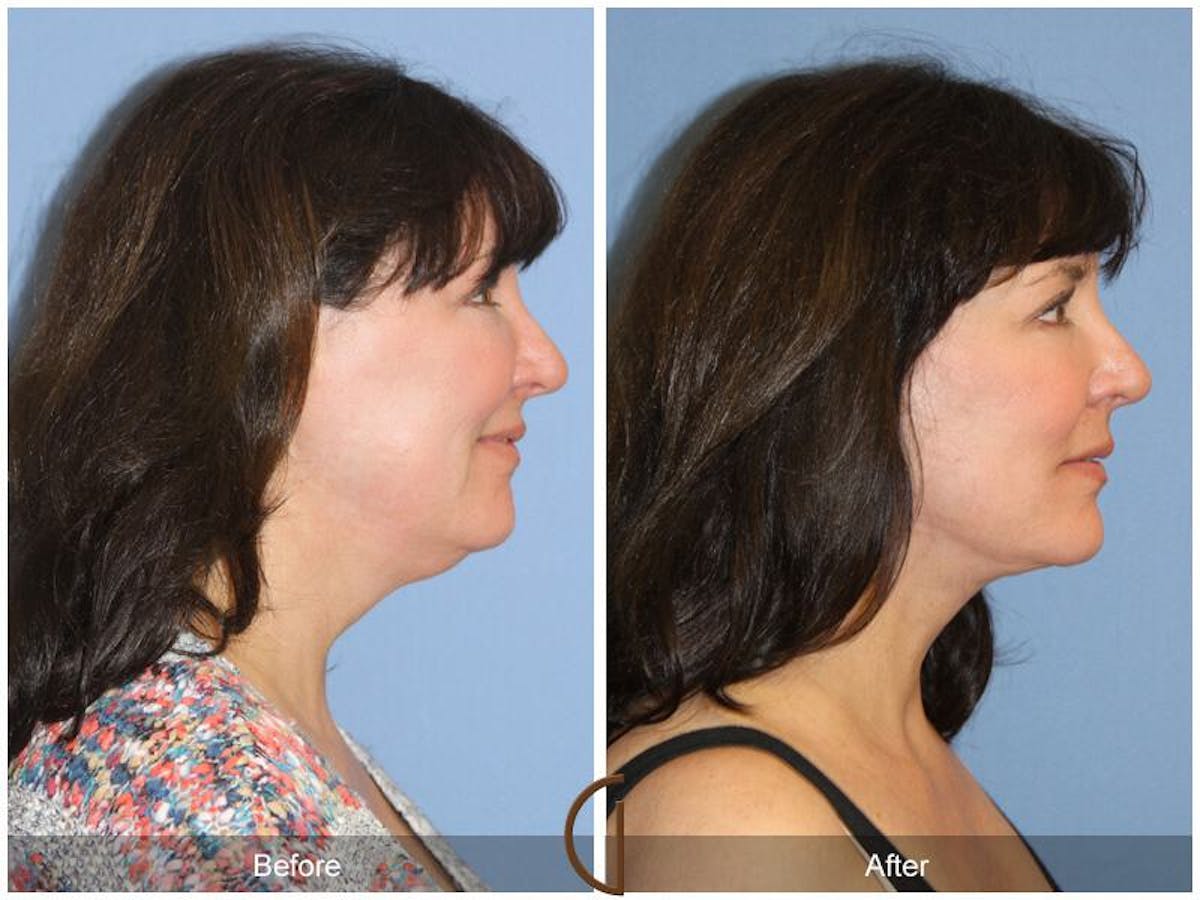 Facelift 40s Before & After Gallery - Patient 139282 - Image 3