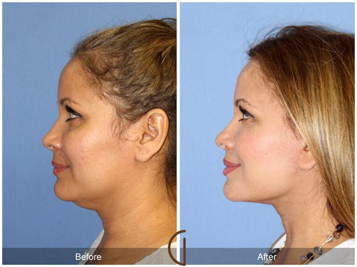 Facelift 40s Before & After Gallery - Patient 382311 - Image 1