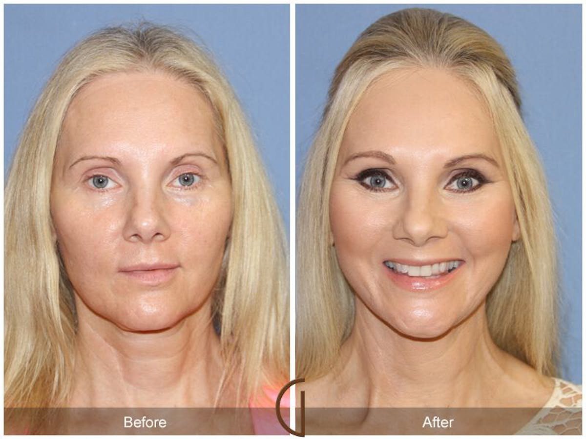 Facelift 40s Before & After Gallery - Patient 367302 - Image 2
