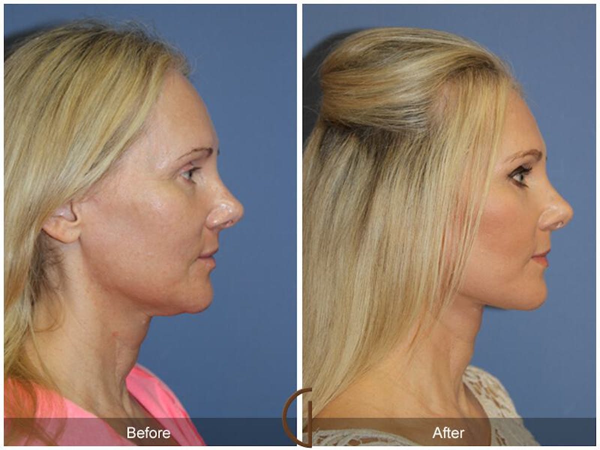 Facelift 40s Before & After Gallery - Patient 367302 - Image 3