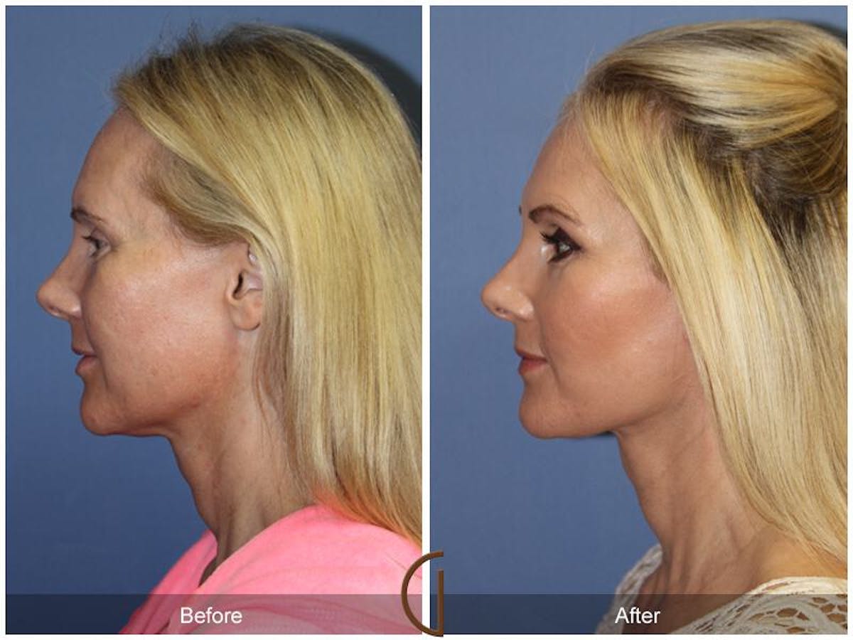 Facelift 40s Before & After Gallery - Patient 367302 - Image 1