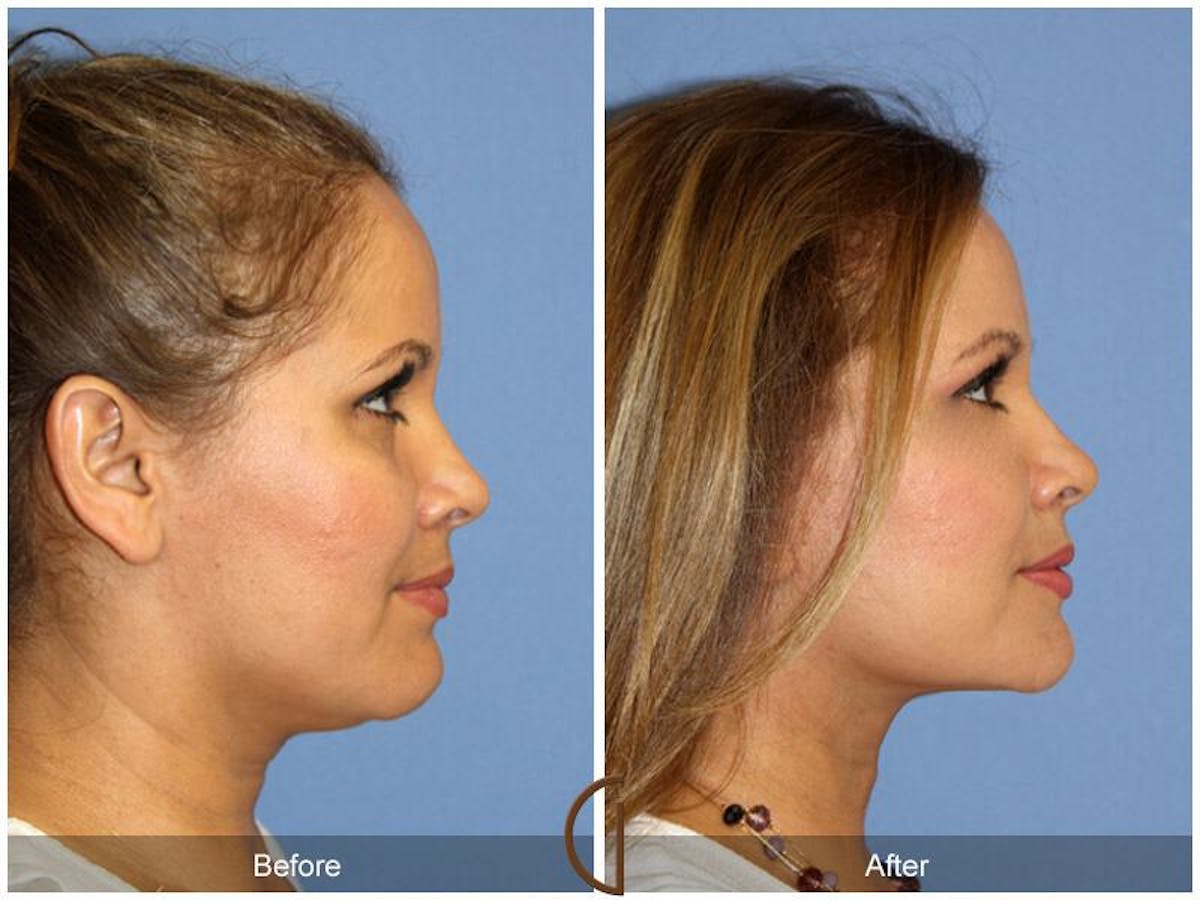 Facelift 40s Before & After Gallery - Patient 382311 - Image 3